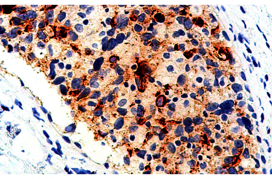Immunohistochemistry - Anti-BCA-225 Antibody [IHC225] (A324508) - Antibodies.com