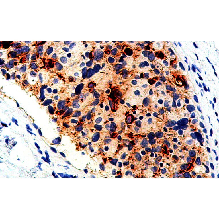 Immunohistochemistry - Anti-BCA-225 Antibody [IHC225] (A324508) - Antibodies.com