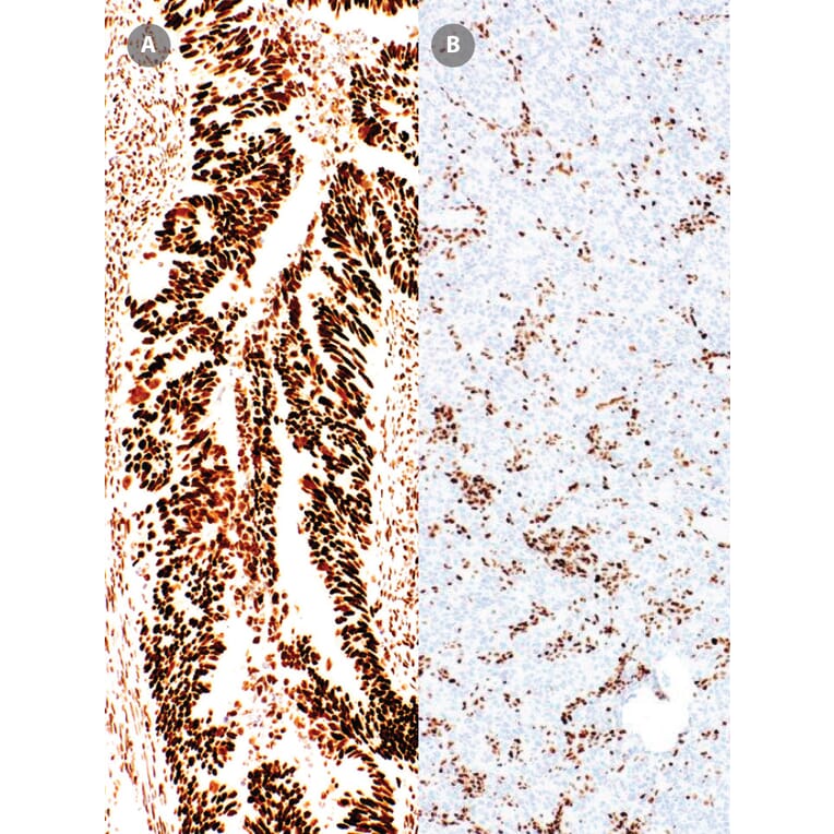 Immunohistochemistry - Anti-MSH6 Antibody [IHC026] (A324547) - Antibodies.com