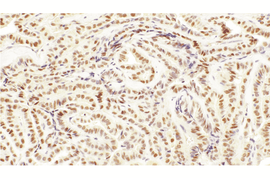 Immunohistochemistry - Anti-TFE3 Antibody [IHC108] (A324556) - Antibodies.com