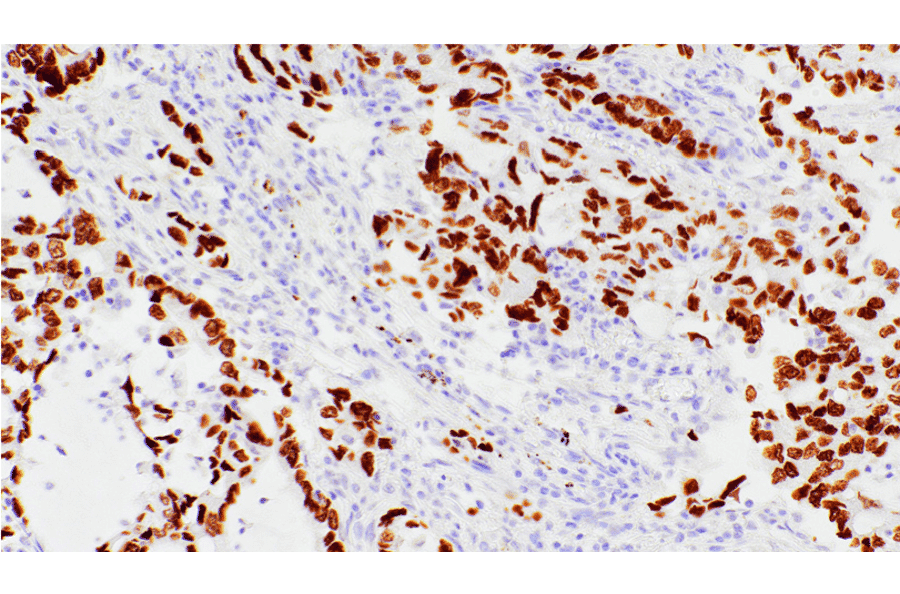 Immunohistochemistry - Anti-TTF1 Antibody [IHC141] (A324560) - Antibodies.com