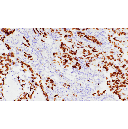 Immunohistochemistry - Anti-TTF1 Antibody [IHC141] (A324560) - Antibodies.com