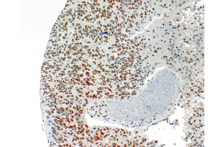 Immunohistochemistry - Anti-ATRX Antibody [IHC703] (A324571) - Antibodies.com