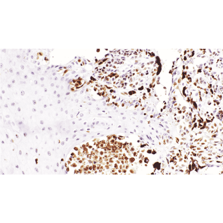 Immunohistochemistry - Anti-PRAME Antibody [IHC092] (A324609) - Antibodies.com