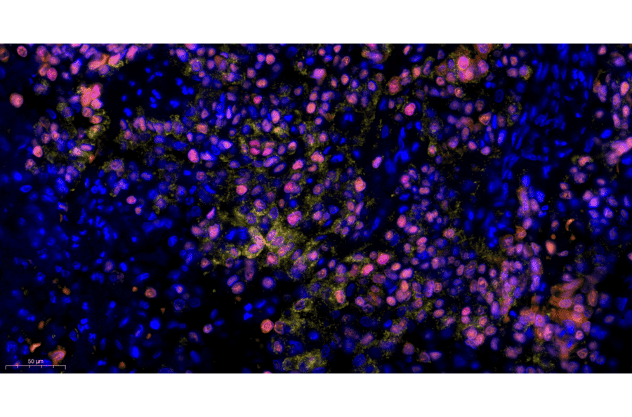 mIHC - mIHC Lung Cancer TME Panel I - 5 Color (A334690) - Antibodies.com