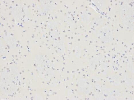 Immunohistochemistry analysis of paraffin-embedded human thyroid cancer using SELENBP1 antibody at dilution of 1: 200 (400x lens).