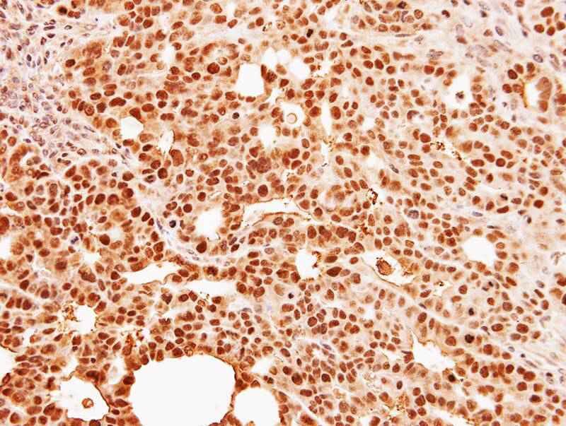 Immunohistochemical analysis of paraffin-embedded NCI-N87 xenograft, using C9orf78 antibody at 1: 500 dilution.