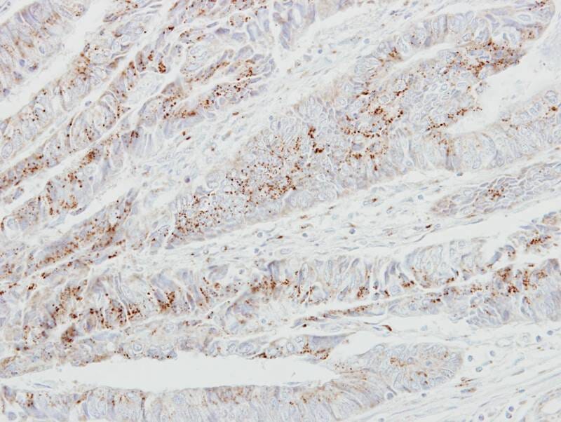 Immunohistochemical analysis of paraffin-embedded Colon ca, using GALNT2 antibody at 1: 250 dilution.