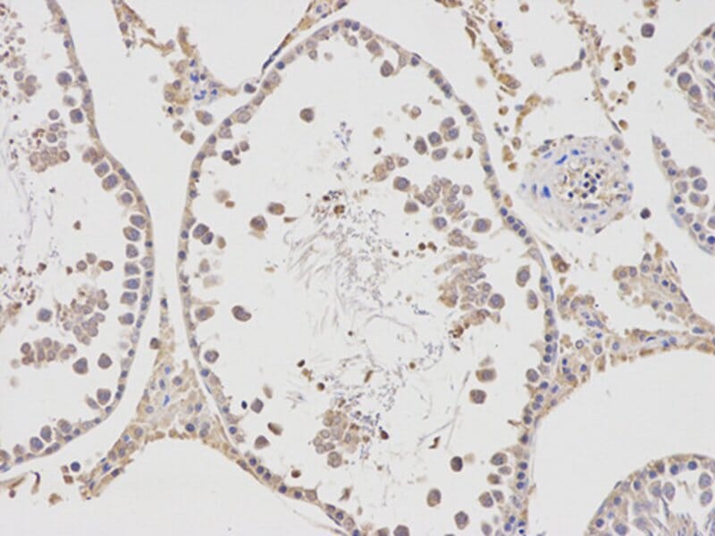 Immunohistochemical analysis of paraffin-embedded human lung cancer using APBB1 antibody at dilution of 1: 100 (200x lens).