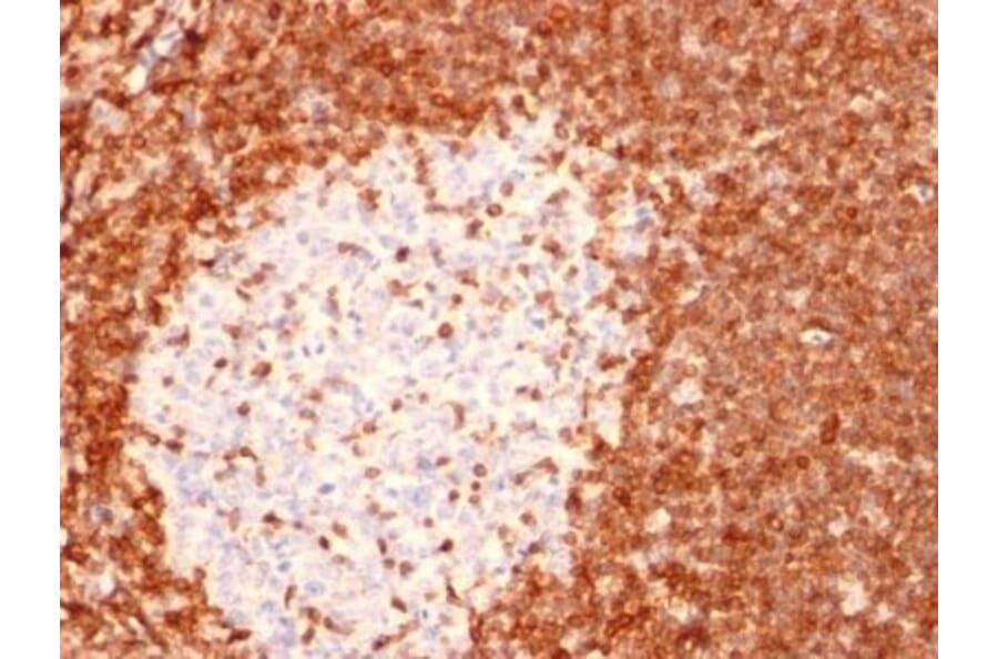 Immunohistochemistry (formalin-fixed, paraffin-embedded) - Anti-Bcl-2 Antibody [8C8] (CF®568) (A352106) - Antibodies.com