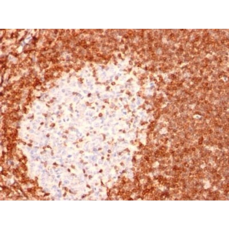 Immunohistochemistry (formalin-fixed, paraffin-embedded) - Anti-Bcl-2 Antibody [8C8] (CF®568) (A352106) - Antibodies.com