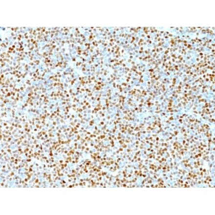 Immunohistochemistry (formalin-fixed, paraffin-embedded) - Anti-Cyclin D1 Antibody [DCS-6] (CF®568) (A352114) - Antibodies.com