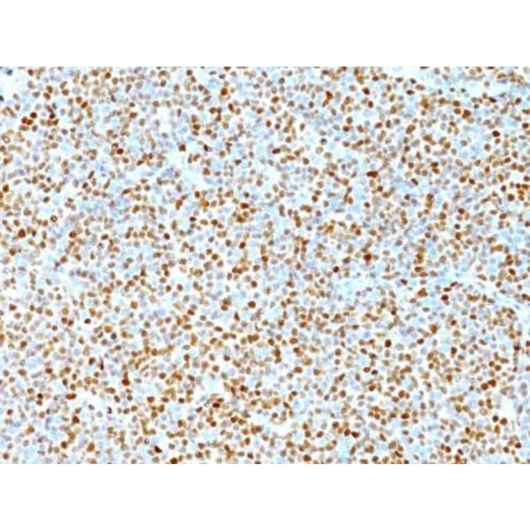 Immunohistochemistry (formalin-fixed, paraffin-embedded) - Anti-Cyclin D1 Antibody [DCS-6] (CF®568) (A352114) - Antibodies.com