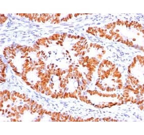 Immunohistochemistry (formalin-fixed, paraffin-embedded) - Anti-p53 Antibody [BP53-12] (CF®640R) (A352120) - Antibodies.com