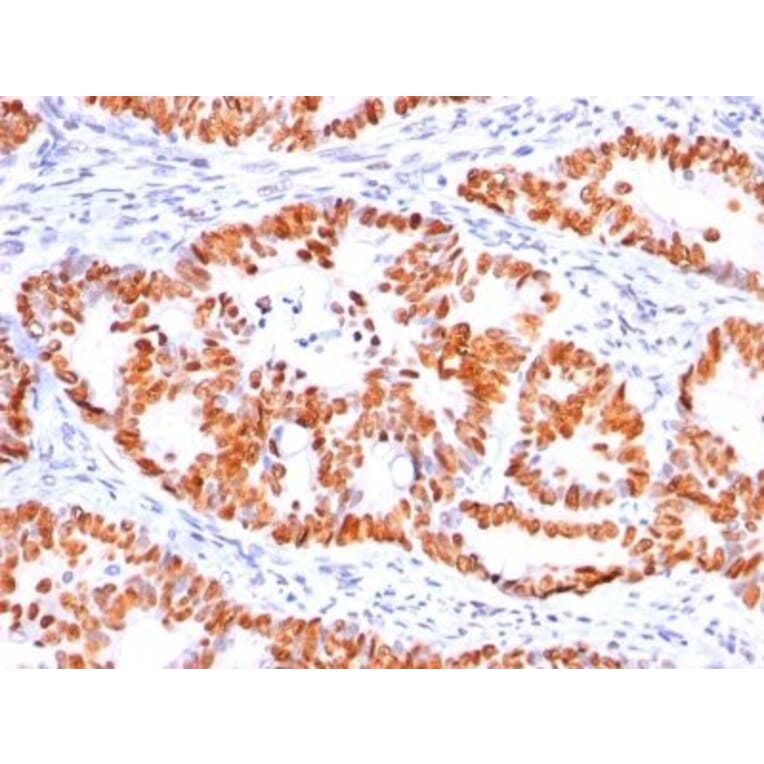 Immunohistochemistry (formalin-fixed, paraffin-embedded) - Anti-p53 Antibody [BP53-12] (CF®647) (A352121) - Antibodies.com