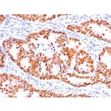 Immunohistochemistry (formalin-fixed, paraffin-embedded) - Anti-p53 Antibody [BP53-12] (CF®647) (A352121) - Antibodies.com