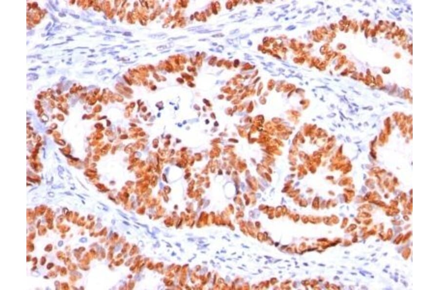 Immunohistochemistry (formalin-fixed, paraffin-embedded) - Anti-p53 Antibody [BP53-12] (CF®488A) (A352124) - Antibodies.com