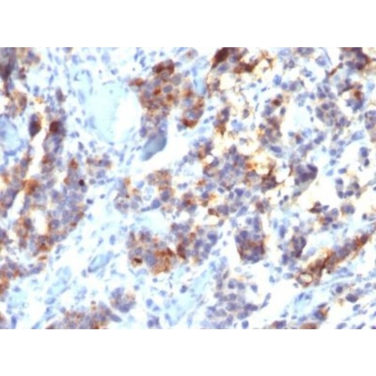 Immunohistochemistry (formalin-fixed, paraffin-embedded) - Anti-MUC5AC Antibody [45M1] (CF®405S) (A352136) - Antibodies.com