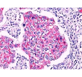Immunohistochemistry (formalin-fixed, paraffin-embedded) - Anti-beta Catenin Antibody (CF®405S) (A352444) - Antibodies.com