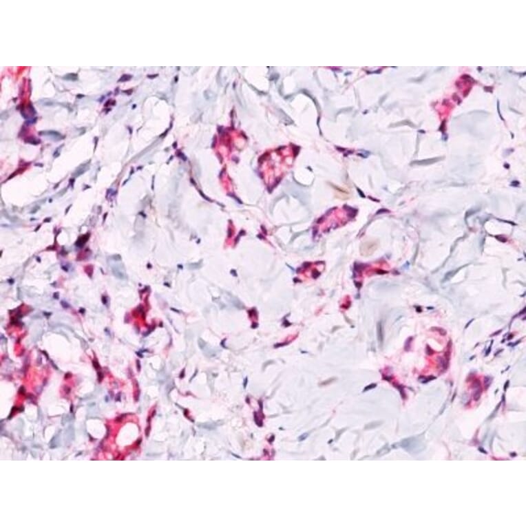 Immunohistochemistry (formalin-fixed, paraffin-embedded) - Anti-beta Catenin Antibody (CF®647) (A352446) - Antibodies.com