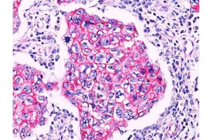 Immunohistochemistry (formalin-fixed, paraffin-embedded) - Anti-beta Catenin Antibody (CF®740) (A352448) - Antibodies.com