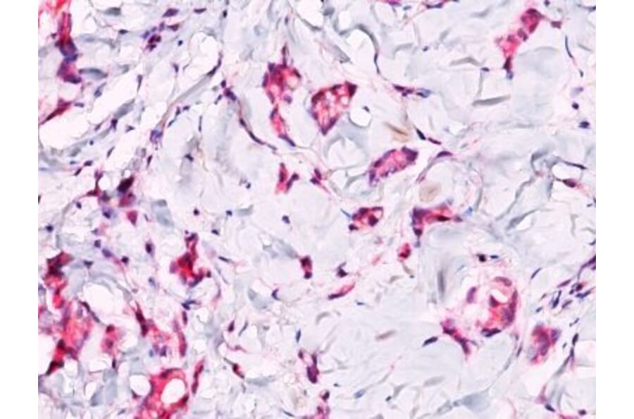 Immunohistochemistry (formalin-fixed, paraffin-embedded) - Anti-beta Catenin Antibody (CF®740) (A352448) - Antibodies.com