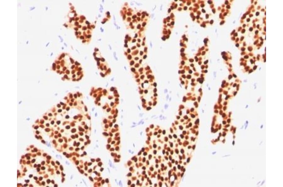 Immunohistochemistry (formalin-fixed, paraffin-embedded) - Anti-Estrogen Receptor alpha Antibody [ER505] (CF®640R) (A352584) - Antibodies.com