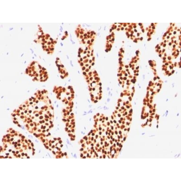 Immunohistochemistry (formalin-fixed, paraffin-embedded) - Anti-Estrogen Receptor alpha Antibody [ER505] (CF®647) (A352585) - Antibodies.com