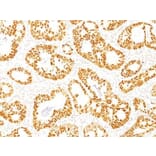 Immunohistochemistry (formalin-fixed, paraffin-embedded) - Anti-p53 Antibody [DO-7] (CF®405S) (A352600) - Antibodies.com