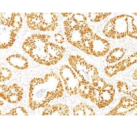 Immunohistochemistry (formalin-fixed, paraffin-embedded) - Anti-p53 Antibody [DO-7] (CF®640R) (A352601) - Antibodies.com