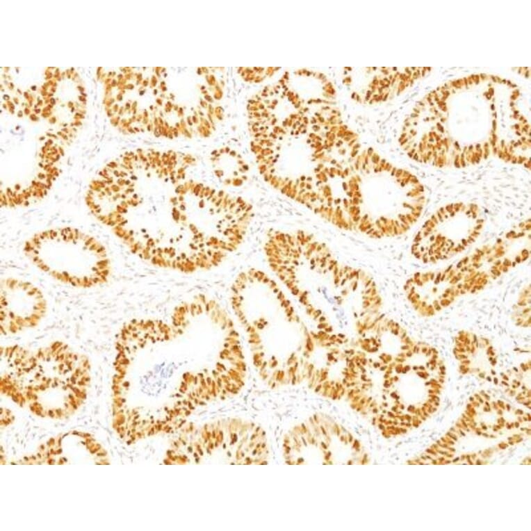 Immunohistochemistry (formalin-fixed, paraffin-embedded) - Anti-p53 Antibody [DO-7] (CF®647) (A352602) - Antibodies.com