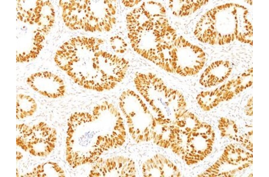 Immunohistochemistry (formalin-fixed, paraffin-embedded) - Anti-p53 Antibody [DO-7] (CF®740) (A352604) - Antibodies.com