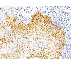 Immunohistochemistry (formalin-fixed, paraffin-embedded) - Anti-p53 Antibody [BP53-12 + DO-7] (CF®488A) (A352753) - Antibodies.com