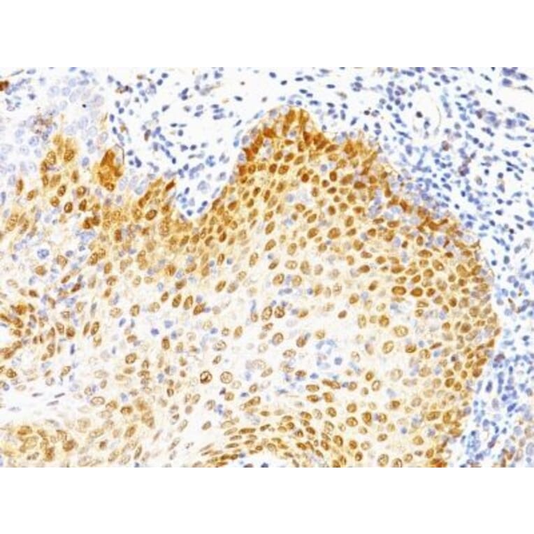 Immunohistochemistry (formalin-fixed, paraffin-embedded) - Anti-p53 Antibody [BP53-12 + DO-7] (CF®488A) (A352753) - Antibodies.com