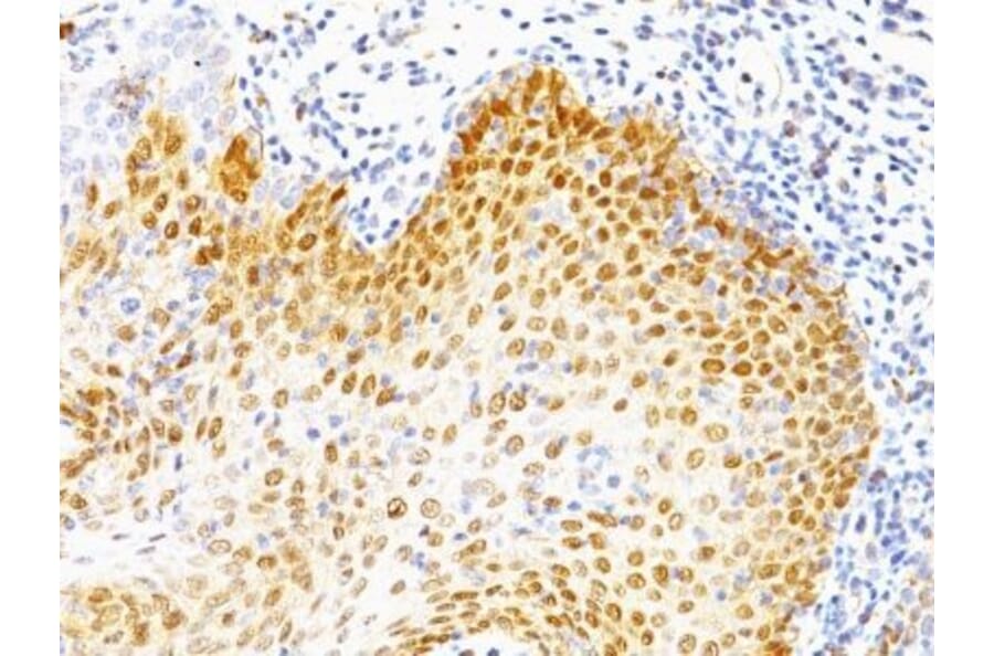 Immunohistochemistry (formalin-fixed, paraffin-embedded) - Anti-p53 Antibody [BP53-12 + DO-7] (Biotin) (A352755) - Antibodies.com
