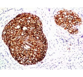 Immunohistochemistry (formalin-fixed, paraffin-embedded) - Anti-ErbB2 Antibody [ERB2/776] (CF®488A) (A352843) - Antibodies.com