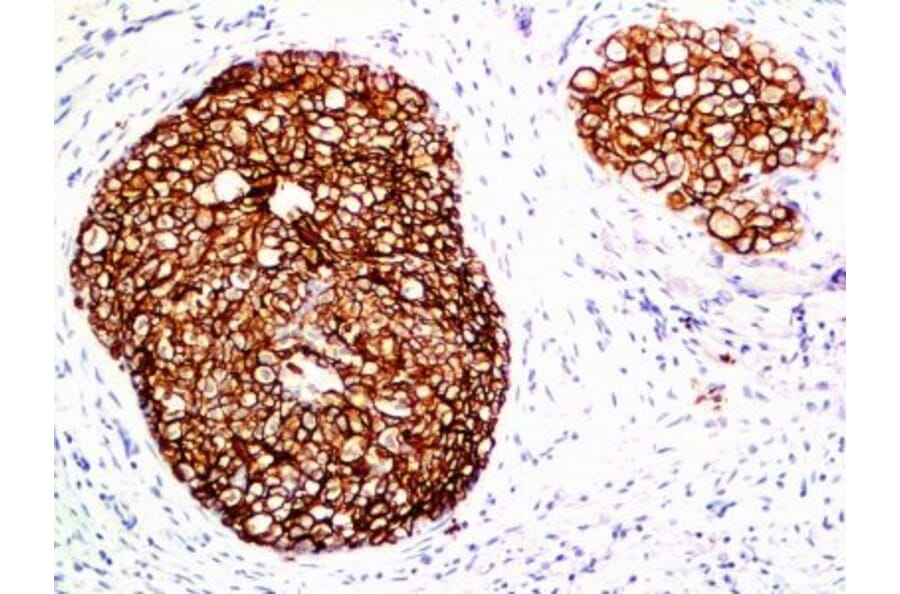 Immunohistochemistry (formalin-fixed, paraffin-embedded) - Anti-ErbB2 Antibody [ERB2/776] (CF®488A) (A352843) - Antibodies.com