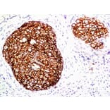 Immunohistochemistry (formalin-fixed, paraffin-embedded) - Anti-ErbB2 Antibody [ERB2/776] (CF®488A) (A352843) - Antibodies.com