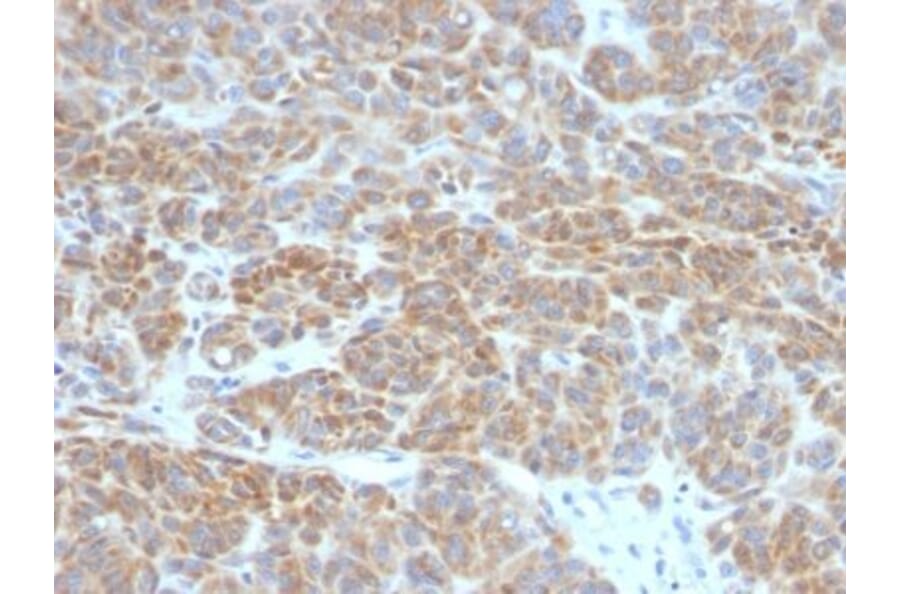 Immunohistochemistry (formalin-fixed, paraffin-embedded) - Anti-Bcl-2 Antibody [BCL2/782] (CF®640R) (A352847) - Antibodies.com
