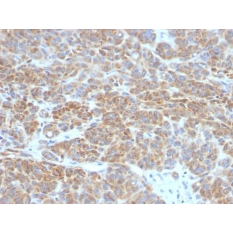 Immunohistochemistry (formalin-fixed, paraffin-embedded) - Anti-Bcl-2 Antibody [BCL2/782] (CF®740) (A352850) - Antibodies.com