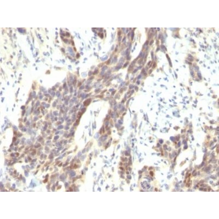 Immunohistochemistry (formalin-fixed, paraffin-embedded) - Anti-Cyclin D1 Antibody [CCND1/809] (CF®405S) (A352878) - Antibodies.com