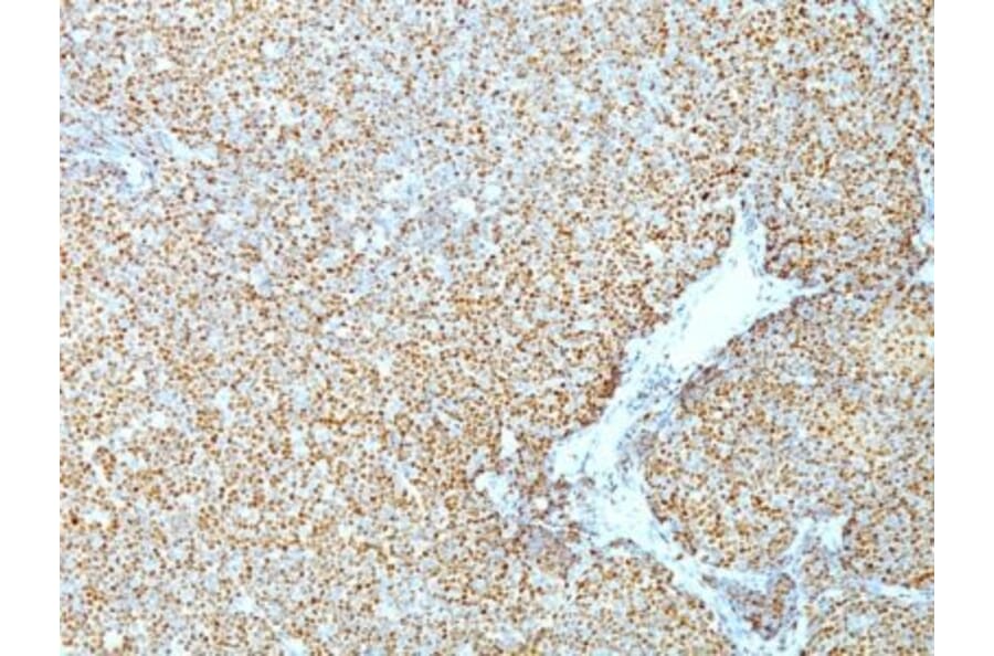 Immunohistochemistry (formalin-fixed, paraffin-embedded) - Anti-Cyclin D1 Antibody [CCND1/809] (CF®640R) (A352879) - Antibodies.com