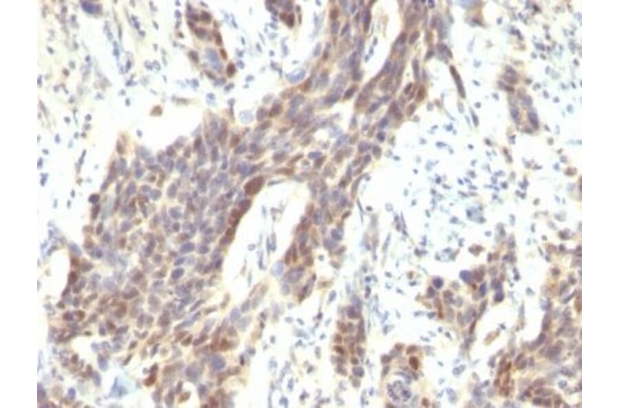 Immunohistochemistry (formalin-fixed, paraffin-embedded) - Anti-Cyclin D1 Antibody [CCND1/809] (CF®640R) (A352879) - Antibodies.com