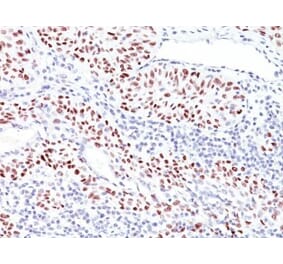 Immunohistochemistry (formalin-fixed, paraffin-embedded) - Anti-p53 Antibody [TRP/816] (CF®405S) (A352887) - Antibodies.com