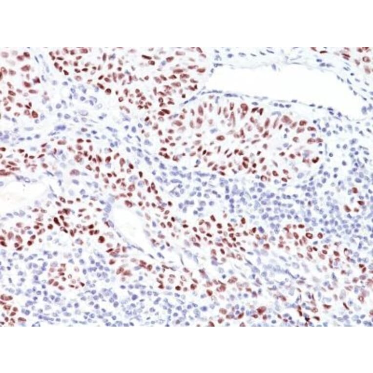 Immunohistochemistry (formalin-fixed, paraffin-embedded) - Anti-p53 Antibody [TRP/816] (CF®647) (A352889) - Antibodies.com