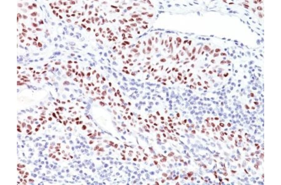 Immunohistochemistry (formalin-fixed, paraffin-embedded) - Anti-p53 Antibody [TRP/816] (CF®740) (A352891) - Antibodies.com