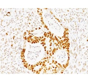 Immunohistochemistry (formalin-fixed, paraffin-embedded) - Anti-p53 Antibody [TRP/817] (CF®640R) (A352896) - Antibodies.com