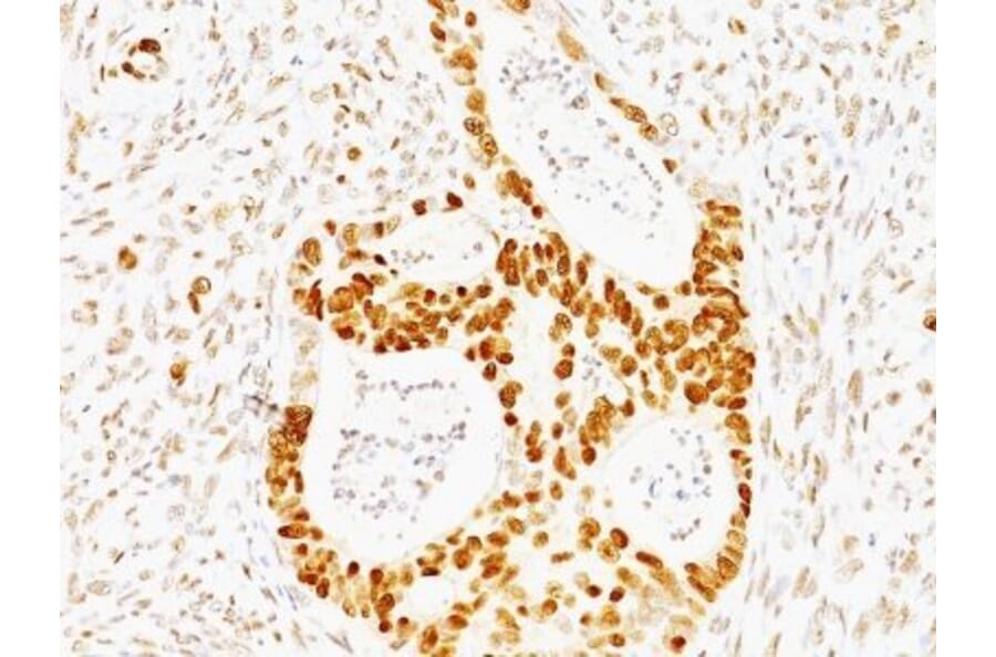 Immunohistochemistry (formalin-fixed, paraffin-embedded) - Anti-p53 Antibody [TRP/817] (CF®647) (A352897) - Antibodies.com