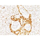 Immunohistochemistry (formalin-fixed, paraffin-embedded) - Anti-p53 Antibody [TRP/817] (CF®594) (A352901) - Antibodies.com