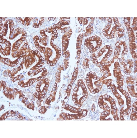 Immunohistochemistry (formalin-fixed, paraffin-embedded) - Anti-MUC5AC Antibody [CLH2] (CF®568) (A352930) - Antibodies.com